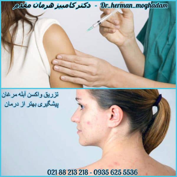 واکسن آبله مرغان